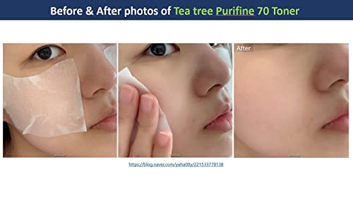 Tea Tree Toner Effective Repairing Acne Treatment with Aloe Vera