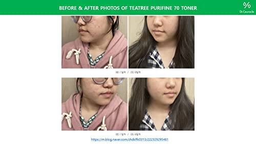 Tea Tree Toner Effective Repairing Acne Treatment with Aloe Vera